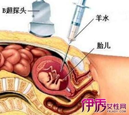 供卵生子的风险(供卵生子风险揭秘：你需要知道的重要事项)