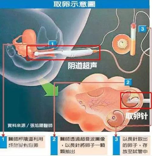 供卵泰国和台湾哪里好-泰国与台湾:哪里更适合供卵?